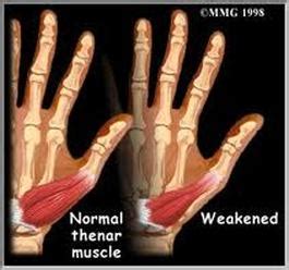 Signs and Symptoms - Carpal Tunnel Syndrome (CTS)