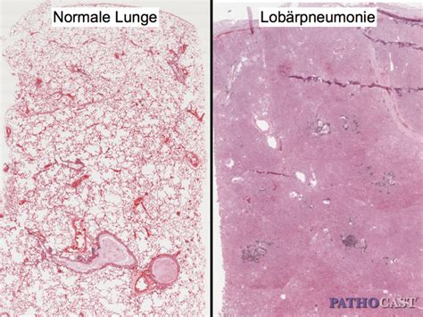 Lobar pneumonia, histology - DocCheck