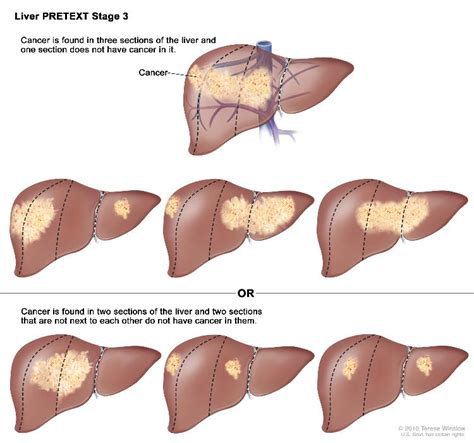 What Are The Four Stages Of Liver Cancer - CancerWalls