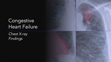 Congestive Heart Failure Chest X Ray Wikidoc - vrogue.co