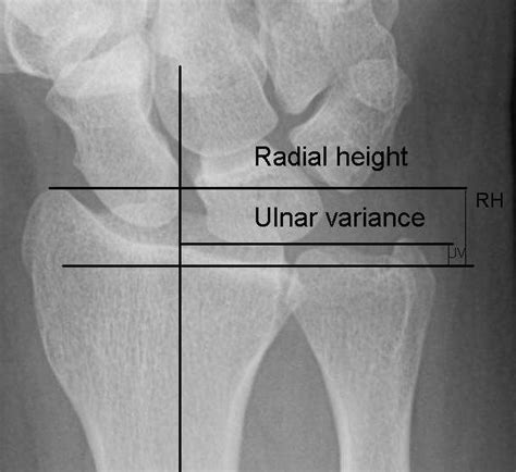 Ulnar Variance - Normal Values, Measurement and Abnormalities | Bone ...