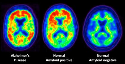 Lifelong brain-stimulating habits linked to lower Alzheimer’s protein levels | Research UC Berkeley