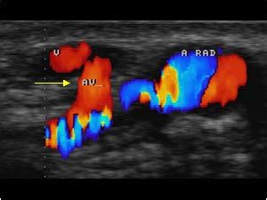 Peripheral vessels | 10.1 Peripheral arteries : Case 10.1.6 True aneurysms, false aneurysms and ...