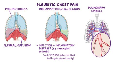 Unbelievable Info About How To Recover From Pleurisy - Springwitness