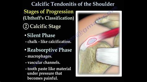 Calcific Tendonitis - Everything You Need To Know - Dr. Nabil Ebraheim - YouTube