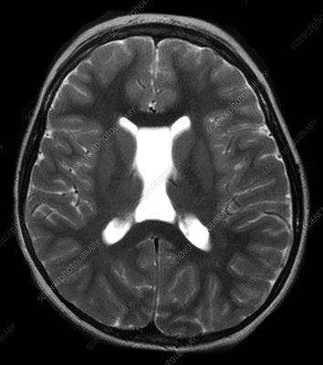 MRI Cavum Septum Pellucidum et Vergae - Stock Image - C043/0386 ...