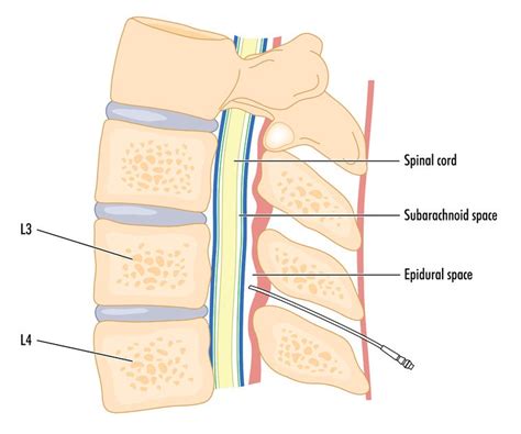 Epidural Steroid Injection – Dr. Mikiko Murakami