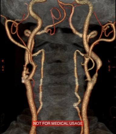 Carotid artery stenosis | Radiology Case | Radiopaedia.org
