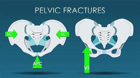 Suing for Broken Pelvis Injuries in Illinois - Find US Lawyers