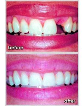 Dental Bridge Before After Photos Image - Graph Diagram