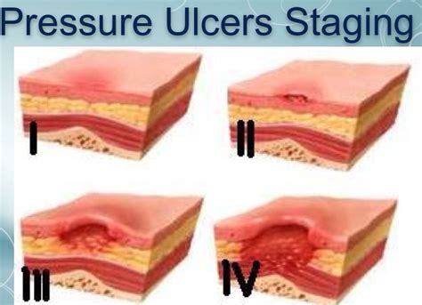 Pressure Ulcer Staging https://www.woundtx.com/ #woundtx Pressure Ulcer Staging, First Aid Tips ...