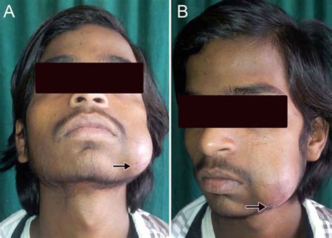 Sialocele causes, symptoms, diagnosis & treatment in humans