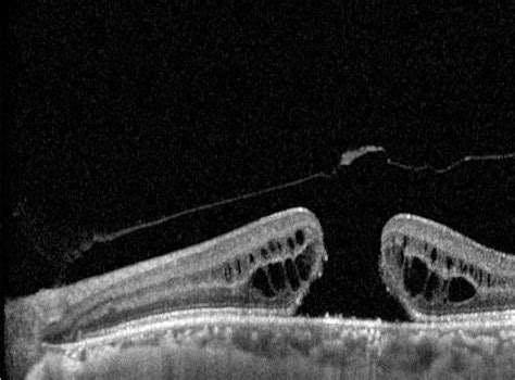 Macular hole: Symptoms & Treatment | SingHealth