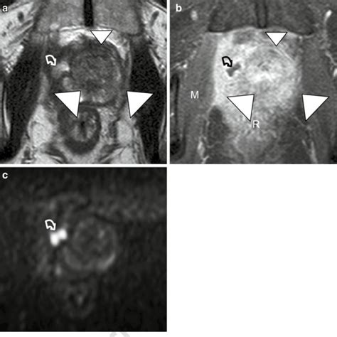 2 Clinically obvious severe acute prostatitis complicated with abscess... | Download Scientific ...