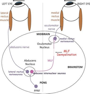 Frontiers | Eye Movement Abnormalities in Multiple Sclerosis: Pathogenesis, Modeling, and ...