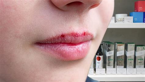 Sunburned Lips - Blisters, Swollen, Treatment, Soothing and Pictures