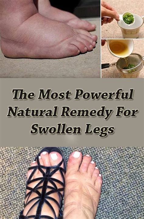 The+Most+Powerful+Natural+Remedy+For+Swollen+Legs | Swollen legs, Foot remedies, Swollen feet remedy