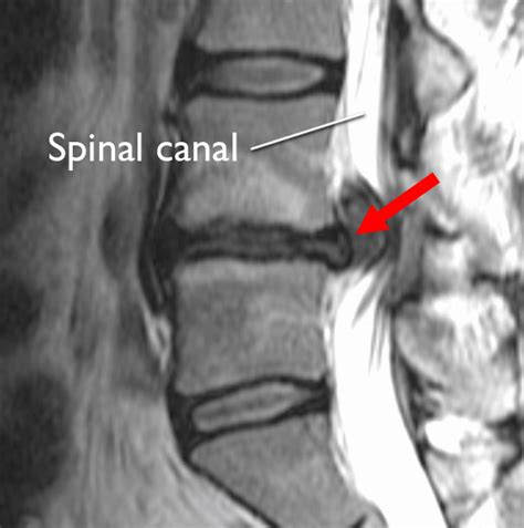 Lumbar Spine Mri Bulging Disc