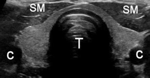 Isthmus Thyroid Ultrasound