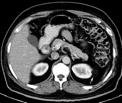 Radiodiagnosis - Imaging is Amazing-Interesting cases: Renal angiomyolipoma-CT