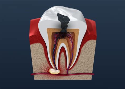 Tooth Root Canal Infection