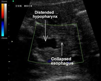 Ultrasound In Tracheo-Esophageal Fistula