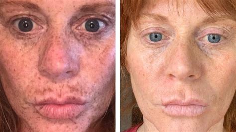 This Dark Spot Serum Has Changed the Lives of Over 4,000 Shoppers | Us ...