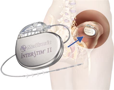 Sacral Neuromodulation (Interstim® Therapy) | Star Clinic