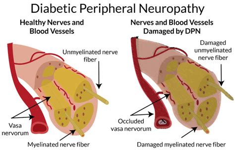 Diabetic Peripheral Neuropathy - Highlands Foot and Ankle