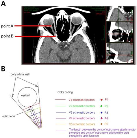 Anatomy and measurements. (A) CT scans of orbits in an axial plane with ...