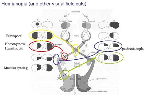 Lecture 7 Visual Perception Dr Roger Newport Hemianopia Visual