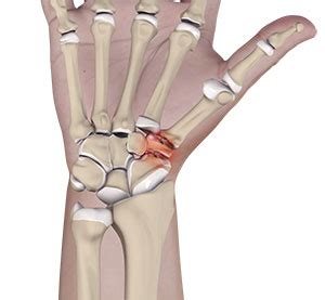 Triscaphoid Joint Arthritis Reston, VA | Staphotrapeziotrapezoid (STT ...