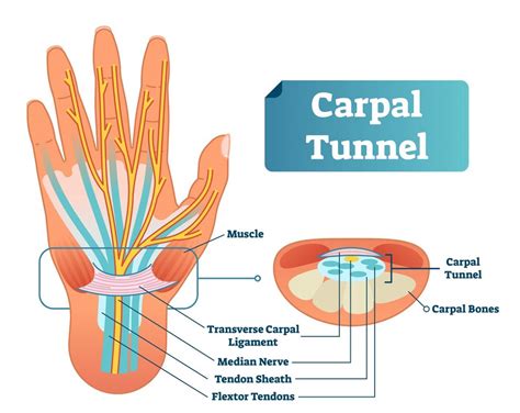 Carpal tunnel syndrome - hetyplant