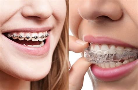 Braces Vs. Invisalign - News & Articles | Blog | Kahan Orthodontics