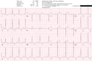 Hyperacute T waves and Occlusion MI | ECG Cases| Emergency Medicine Cases