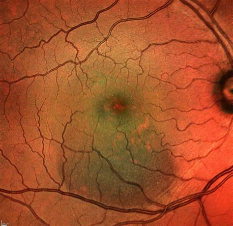 Central Serous Chorioretinopathy - Symptoms - Diagnosis