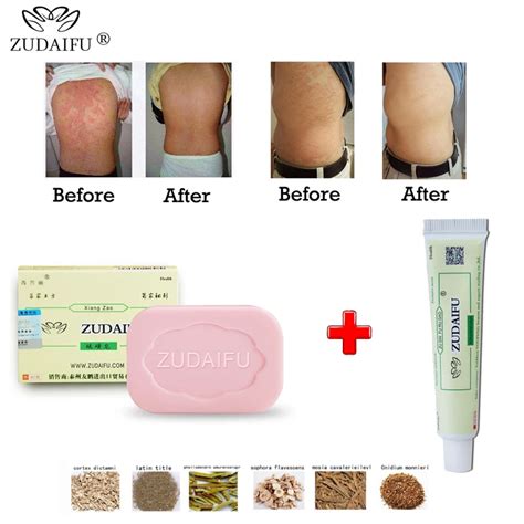 Aliexpress.com : Buy 1 piece Zudaifu Sulfur sulphur Soap skin repair clearance Acne Psoriasis ...