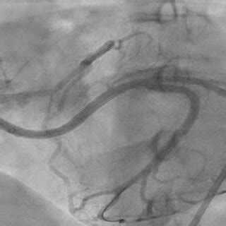 Post procedure angiogram. | Download Scientific Diagram