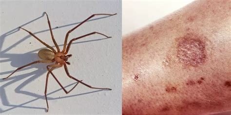 How to treat a spider bite and when to seek medical attention ...