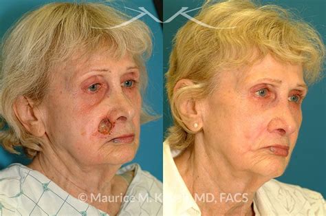 New York Facial Plastic Surgery Moh's Reconstruction Of Lips Before and ...