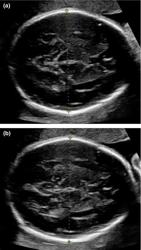 Biparietal diameter measurements using the outer‐to‐outer versus outer ...