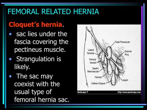 PPT - FEMORAL HERNIA & SLIDING HERNIA PowerPoint Presentation - ID:9423392