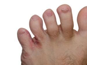 Tinea Pedis | Athletes Foot | Itchy moist skin that splits between your toes