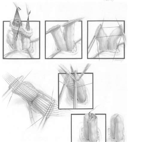 Artistic diagram of the colostomy closure technique | Download Scientific Diagram