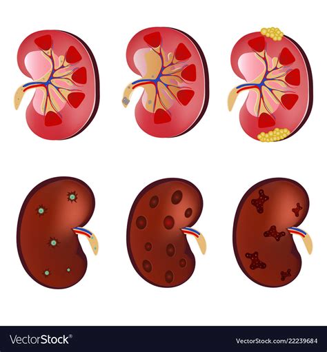 Various kidney diseases can for a long time Vector Image