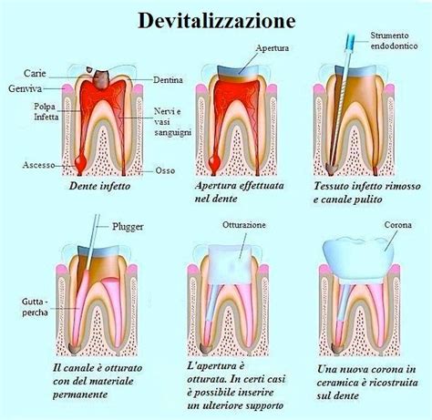 Devitalizzazione Dente Padova | devitalizzazione Dentale