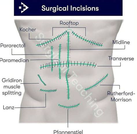 Types of surgical incision - MEDizzy