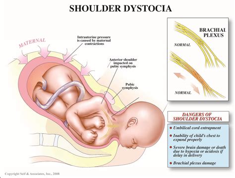 Shoulder Dystocia - Cancer Therapy Advisor