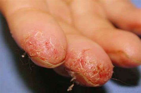 Peeling Fingertips - Pictures, Causes and Treatment