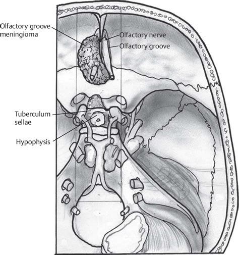 Tuberculum Sellae and Olfactory Groove Meningiomas | Neupsy Key